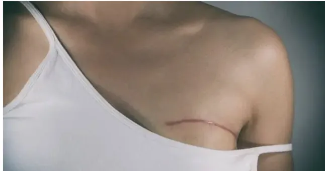 cirugia reconstructiva mama